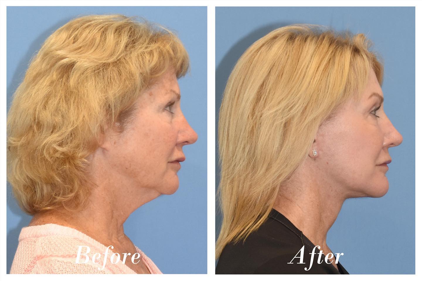 Facelift Upper Blepharoplasty Before & After Image