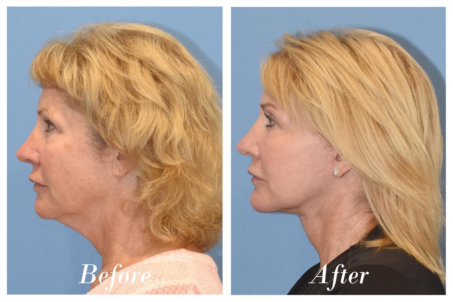 Facelift Upper Blepharoplasty Before & After Image