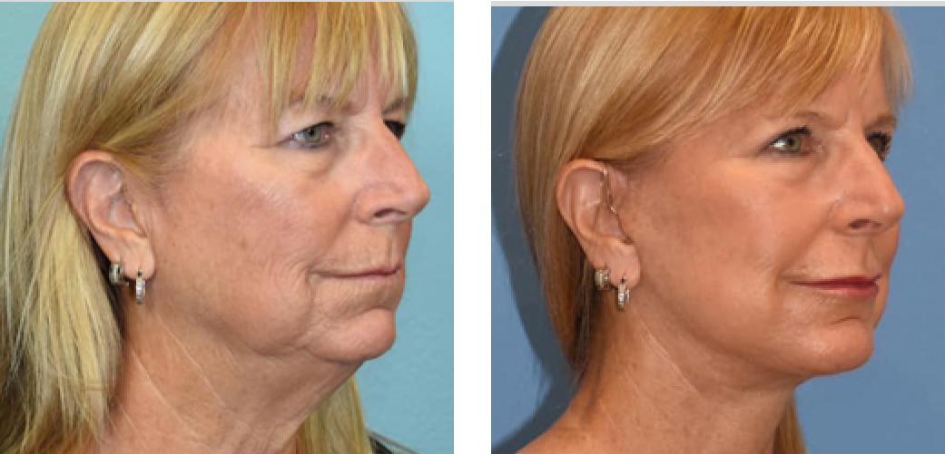 Facelift Before & After Image