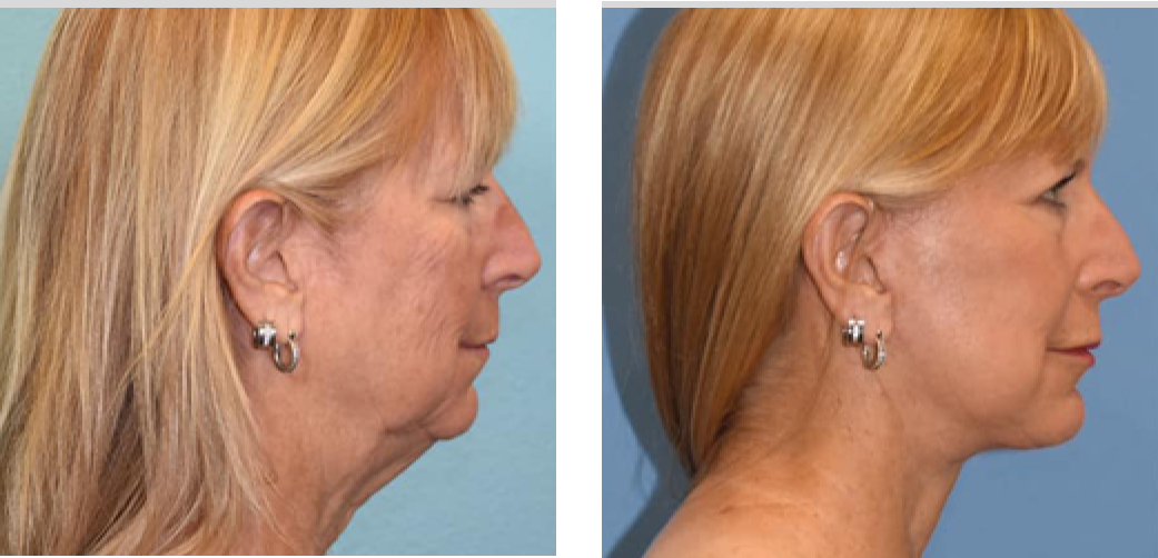 Facelift Before & After Image