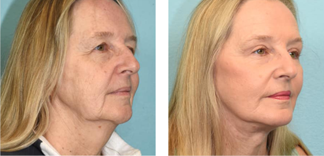 Facelift Before & After Image