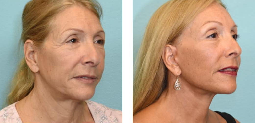 Facelift Before & After Image