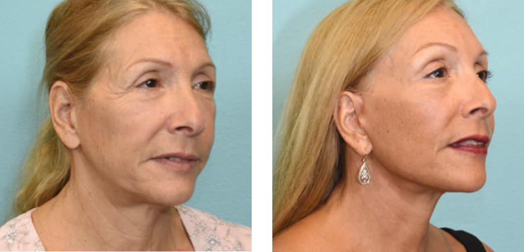 Facelift Before & After Image