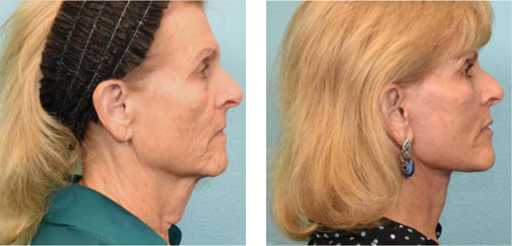 Facelift Before & After Image