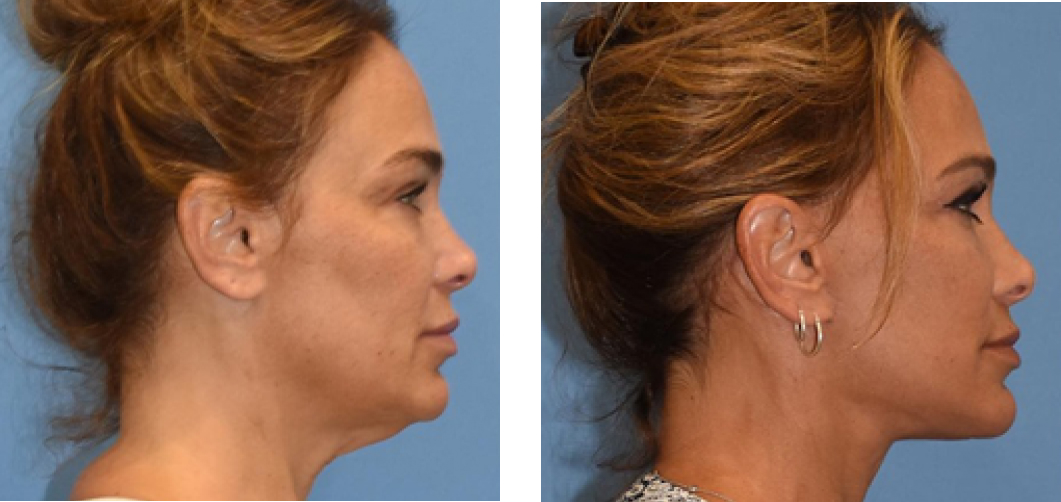 Facelift Before & After Image