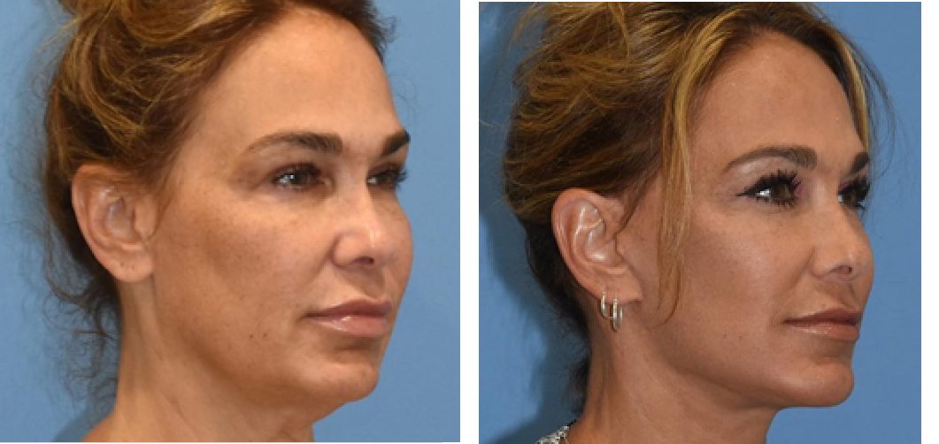 Facelift Before & After Image