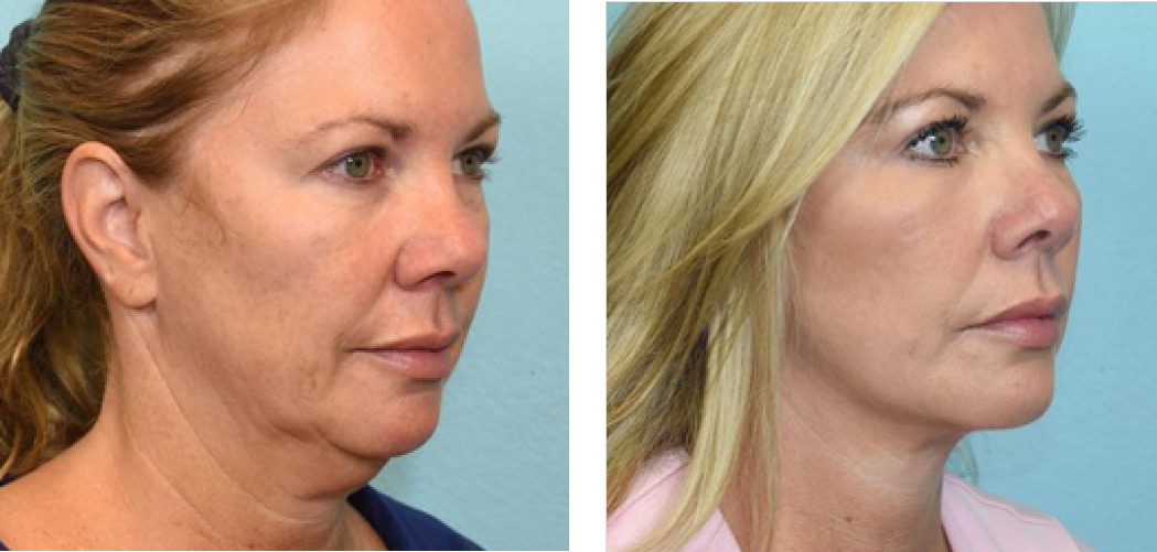 Facelift Before & After Image