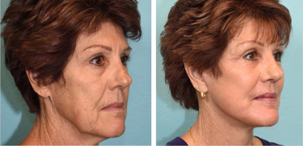 Facelift Before & After Image