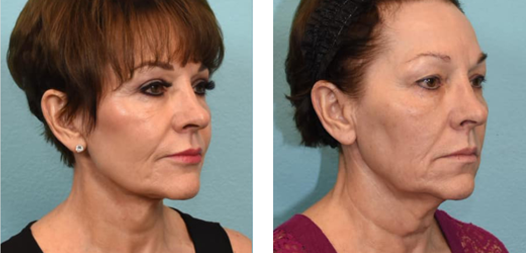 Facelift Before & After Image