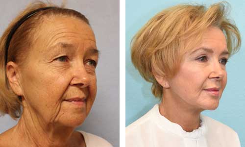 Facelift Before & After Image