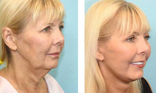 Facelift Before & After Image