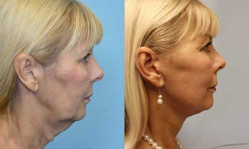 Facelift Before & After Image