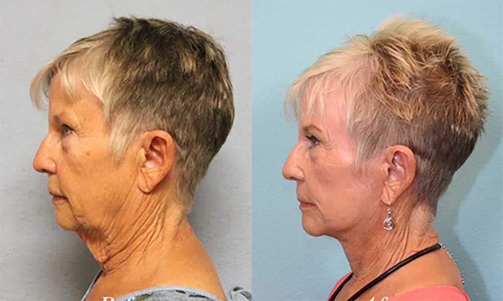 Facelift Before & After Image