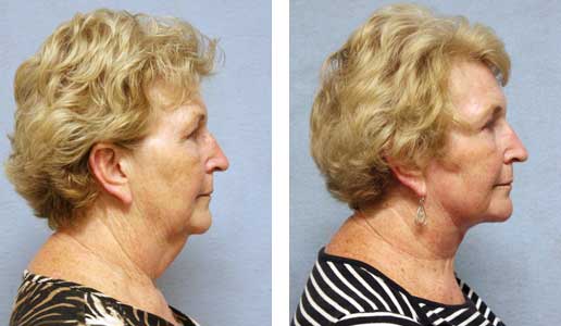 Facelift Before & After Image