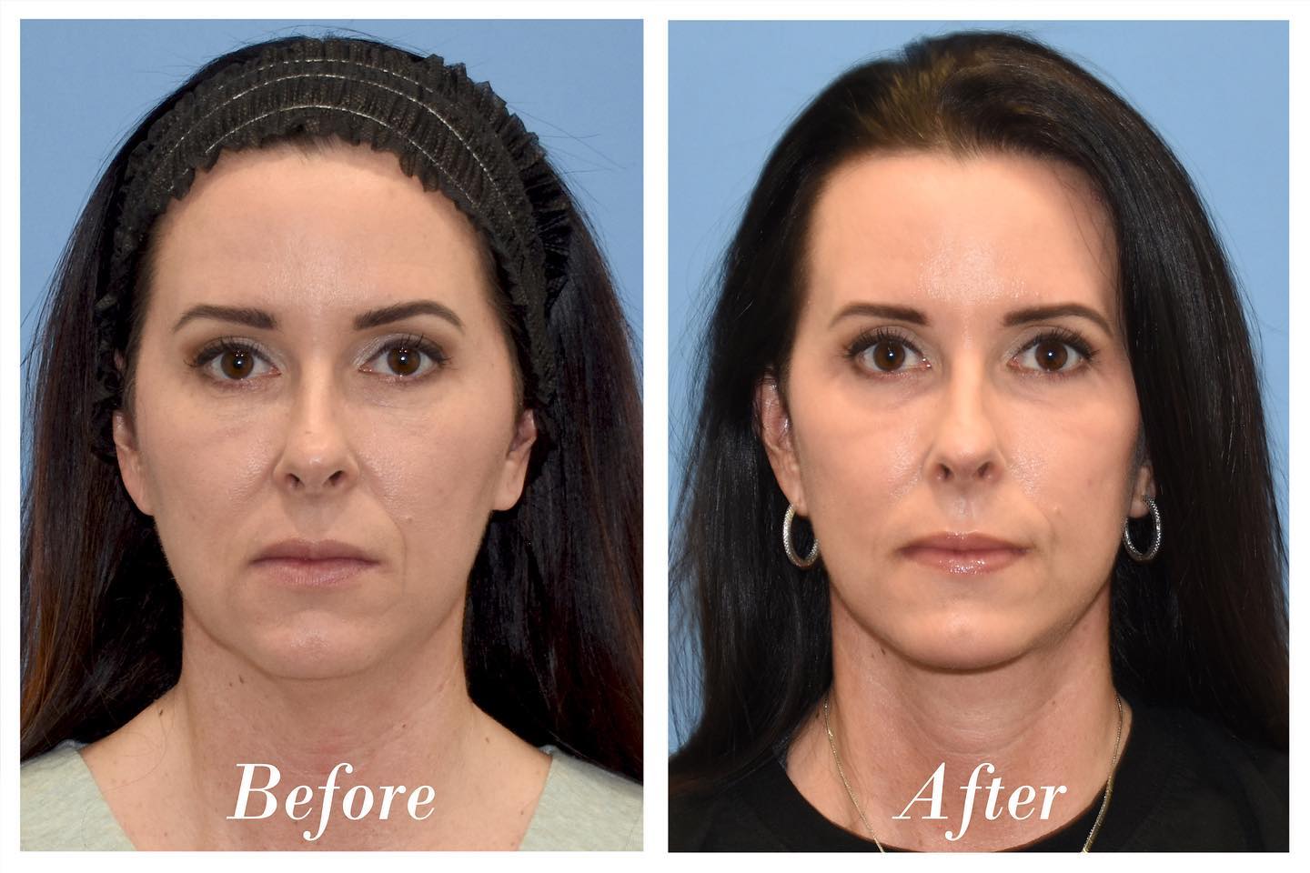 Facelift Before & After Image