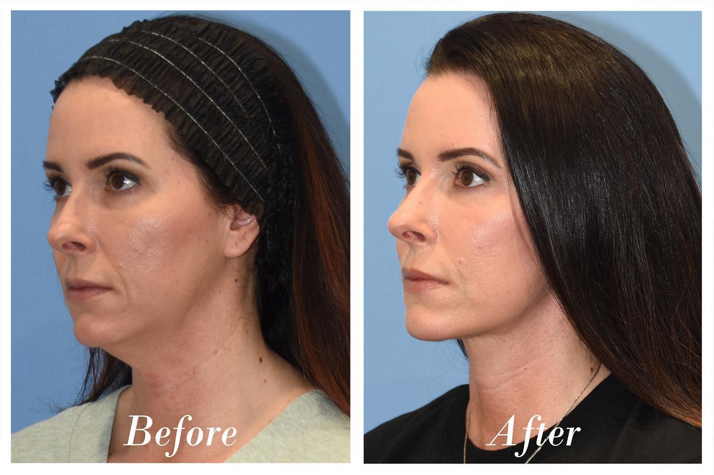 Facelift Before & After Image