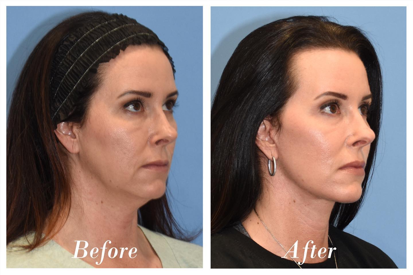 Facelift Before & After Image