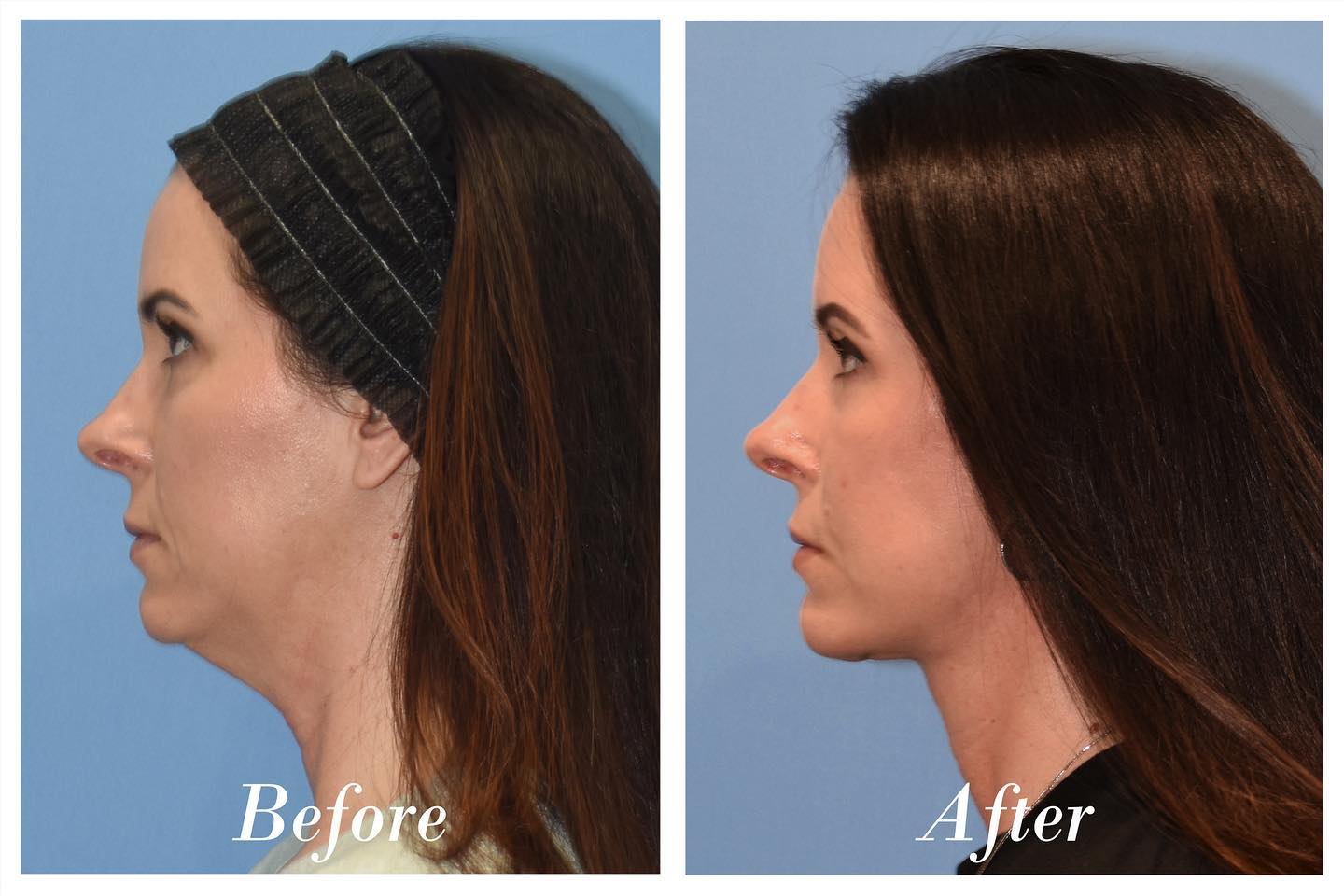 Facelift Before & After Image