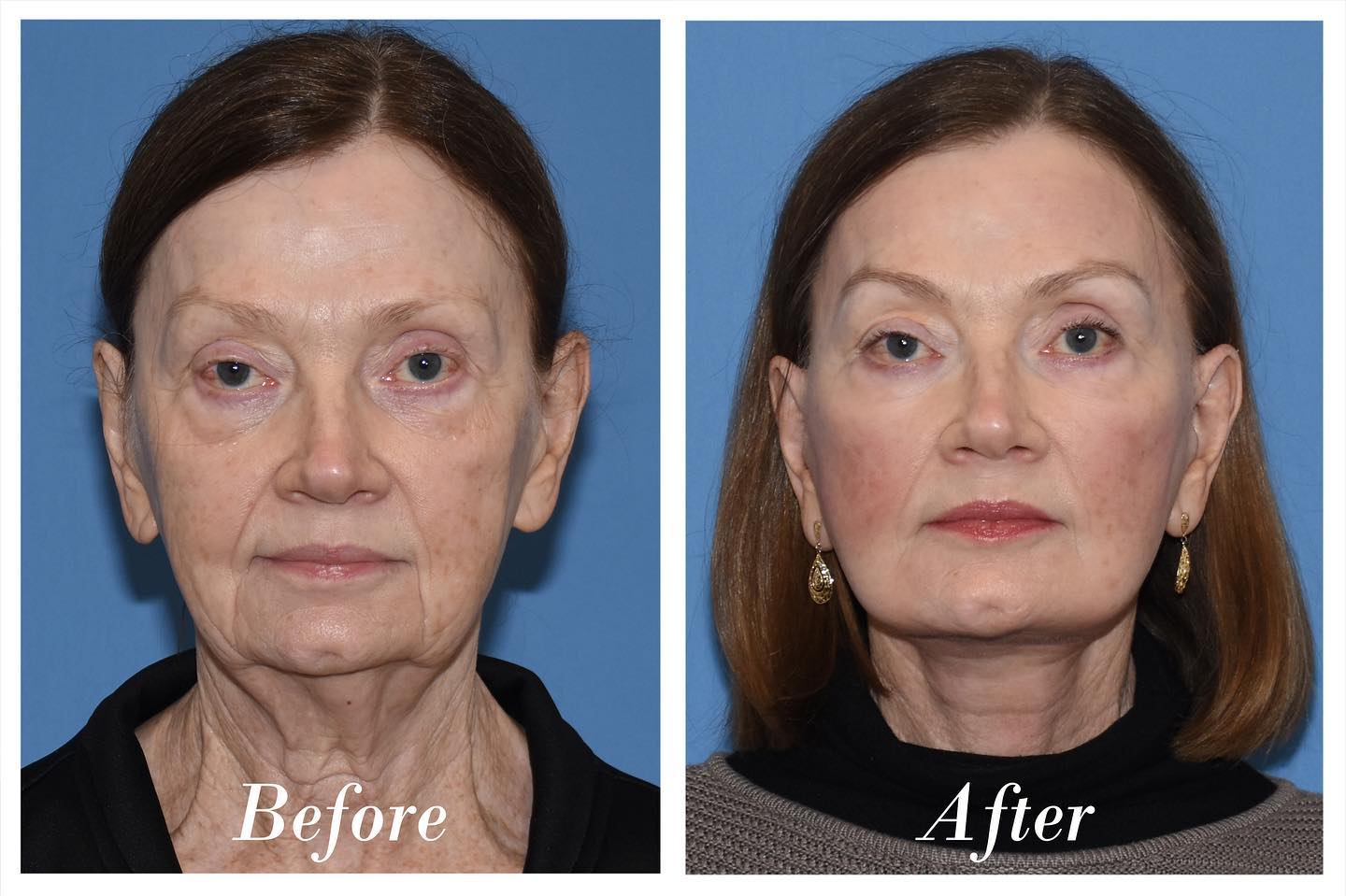 Facelift Before & After Image