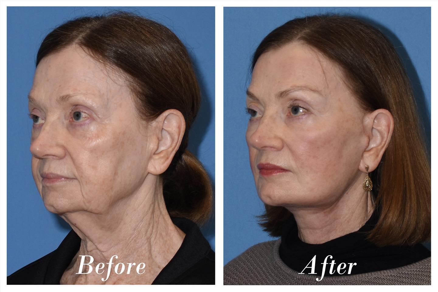 Facelift Before & After Image