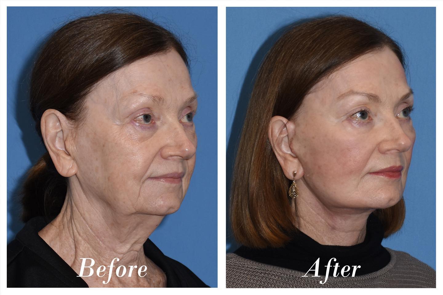 Facelift Before & After Image