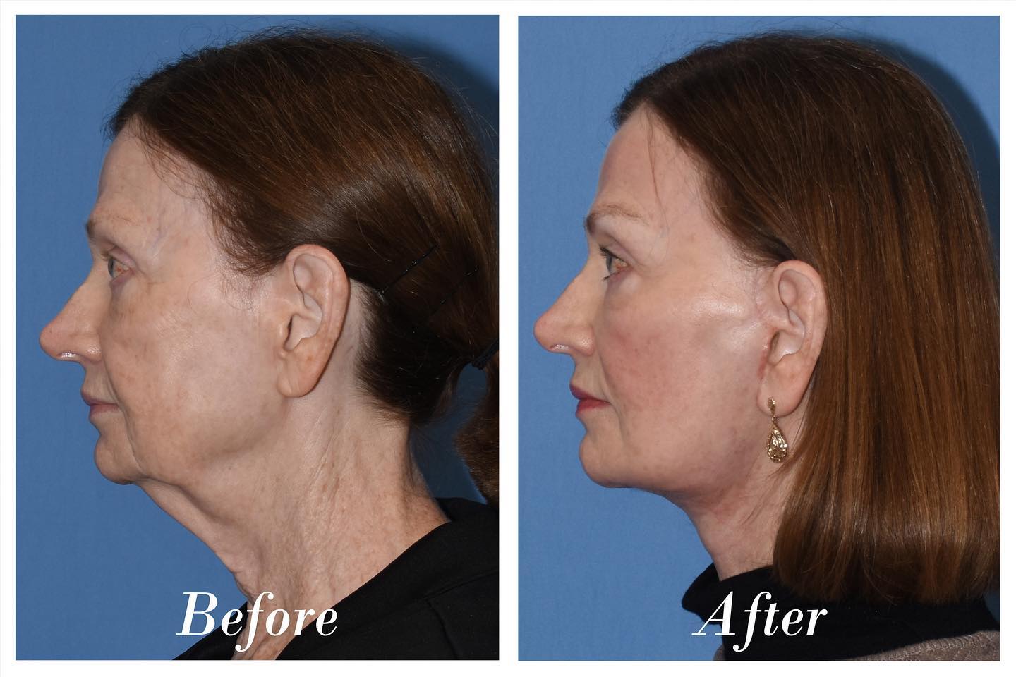 Facelift Before & After Image