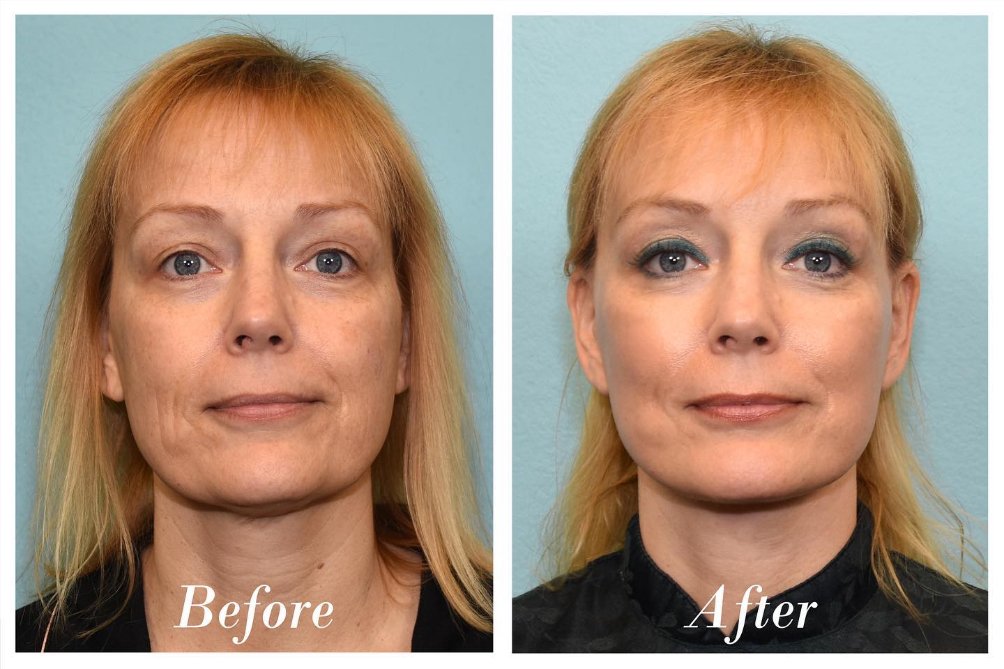 Facelift Before & After Image