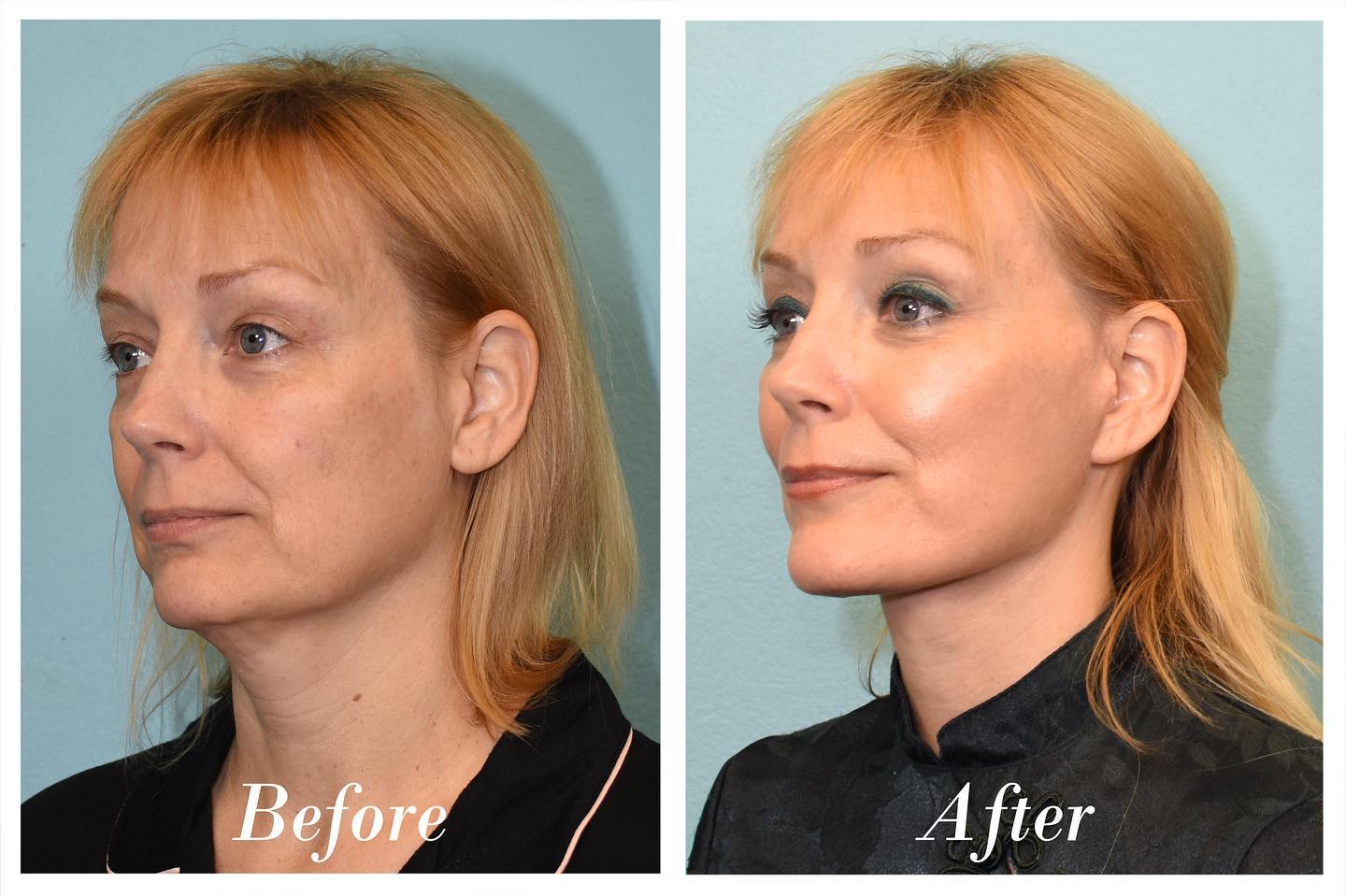 Facelift Before & After Image