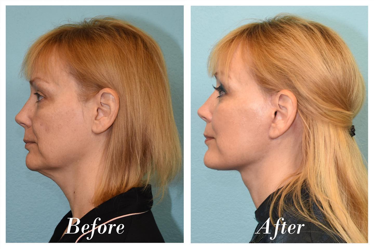 Facelift Before & After Image