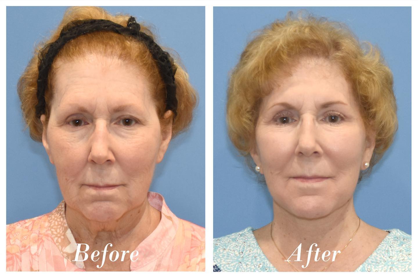 Facelift Before & After Image