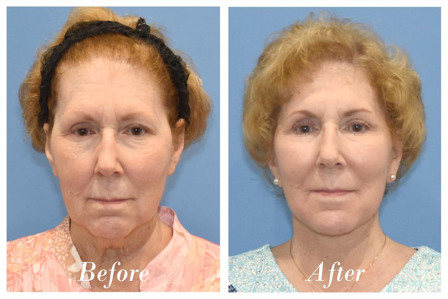 Facelift Before & After Image