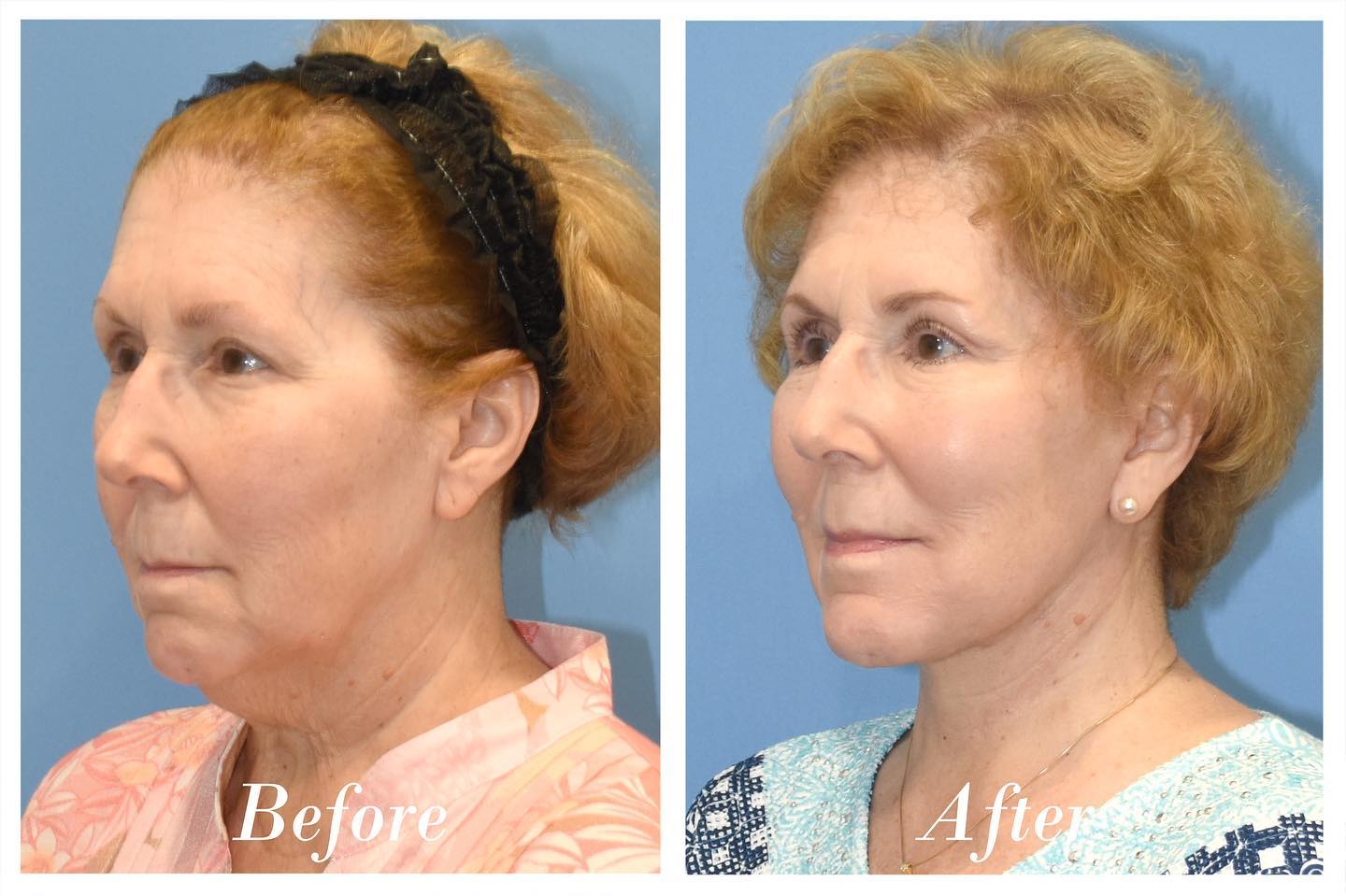 Facelift Before & After Image