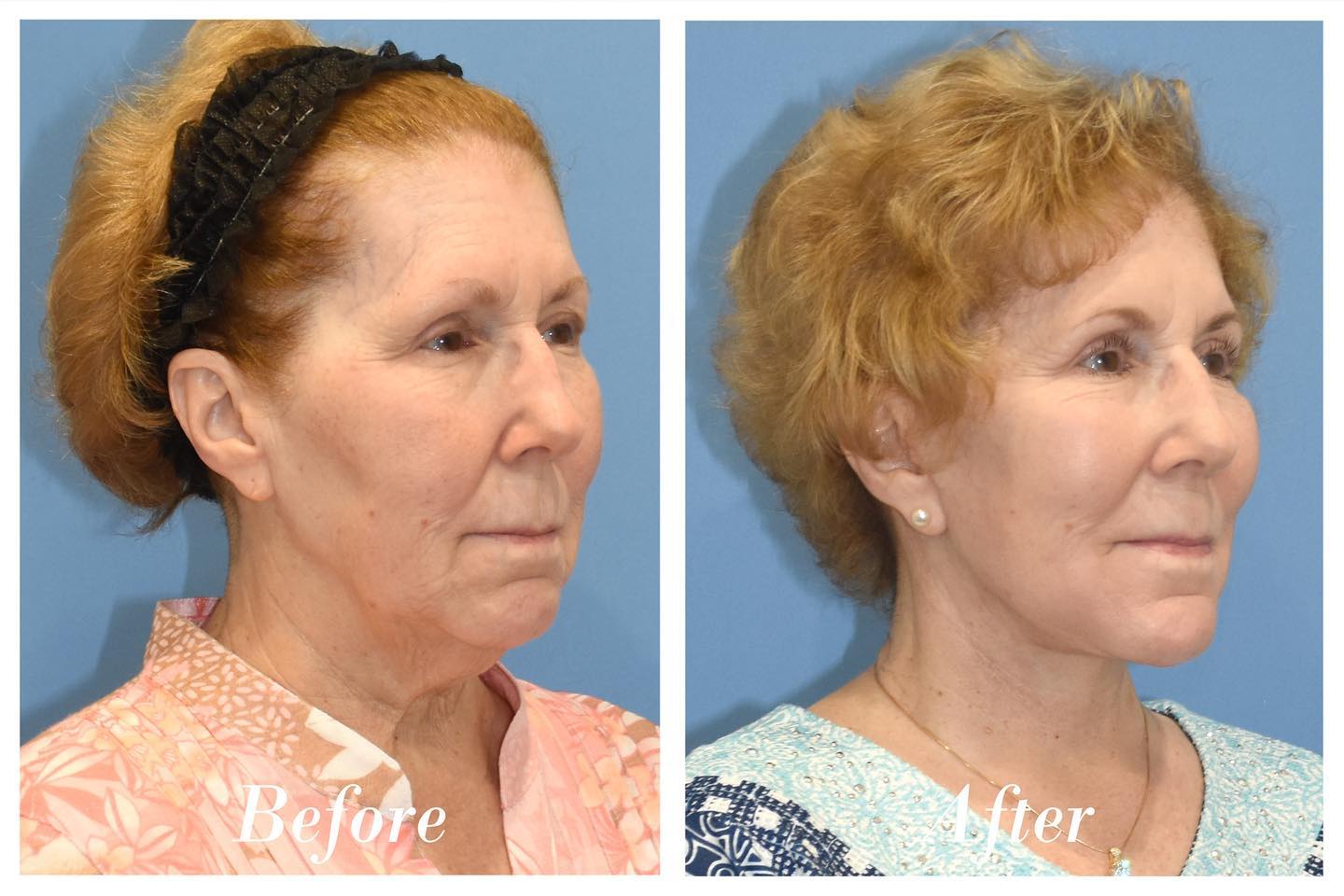 Facelift Before & After Image