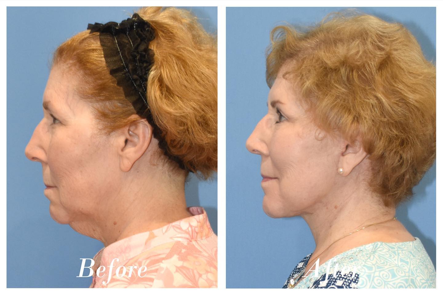 Facelift Before & After Image