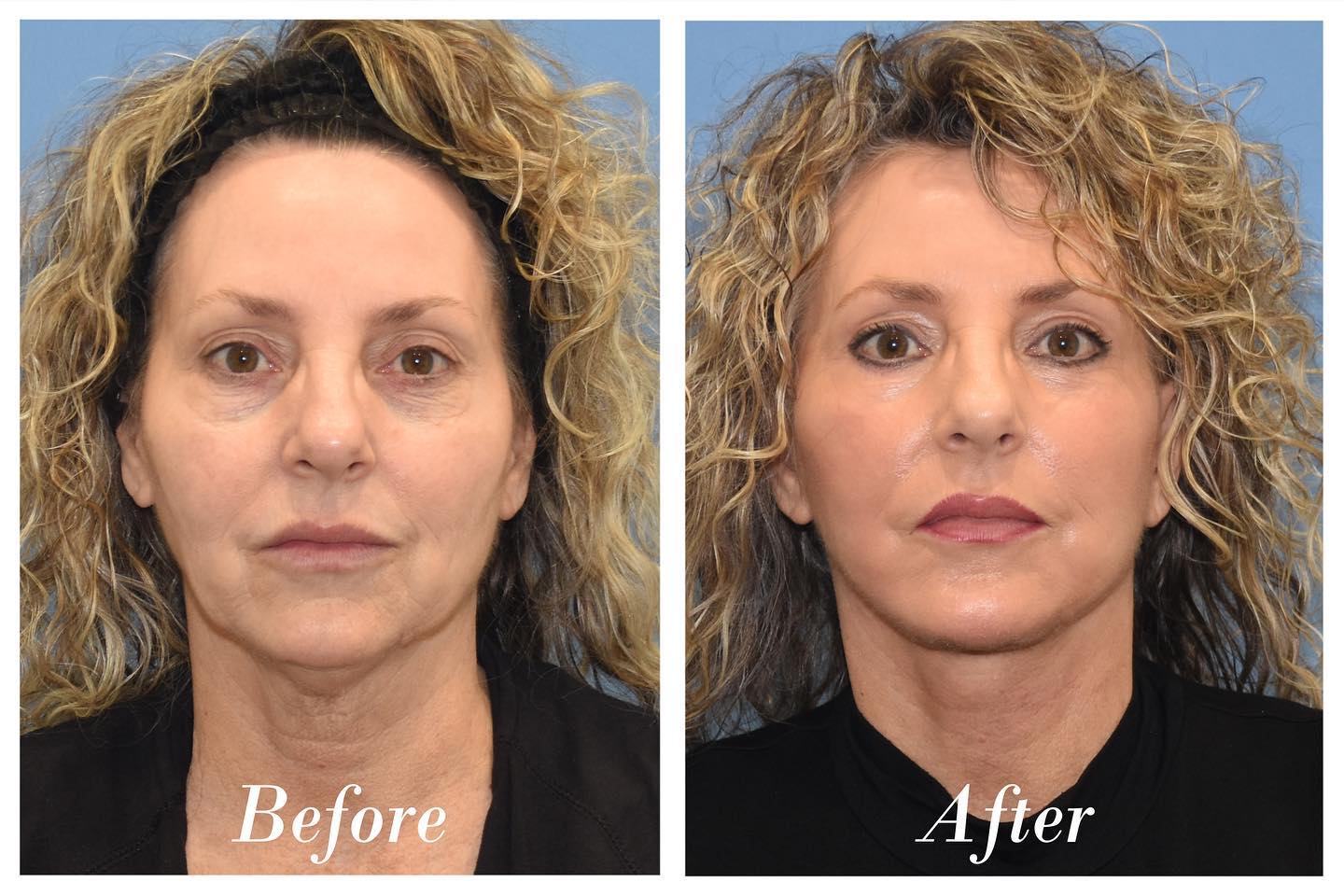 Facelift Before & After Image