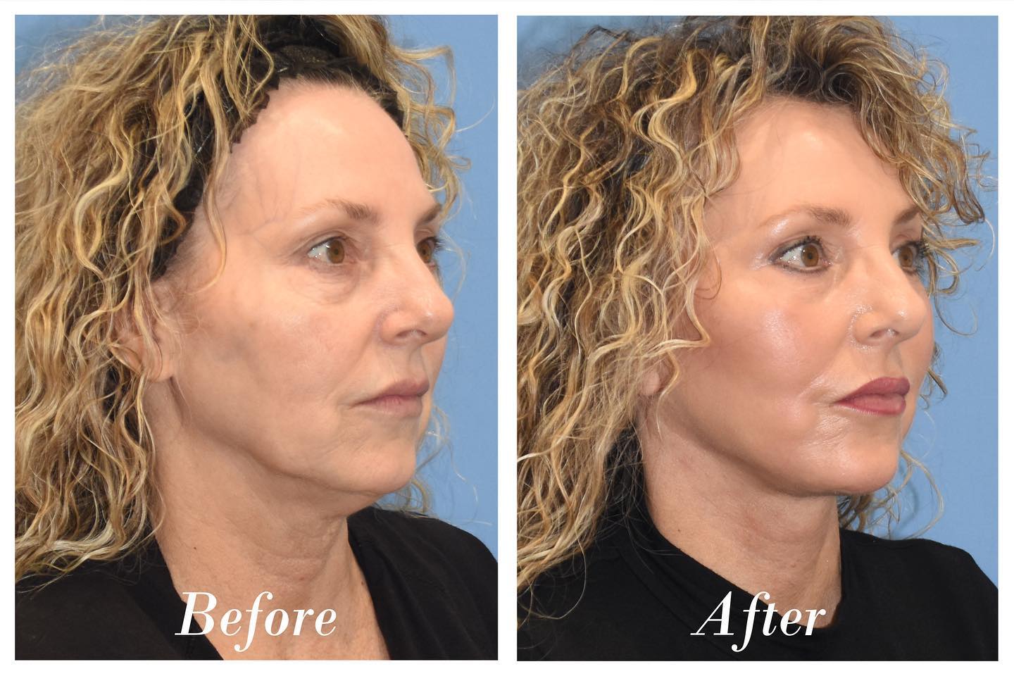 Facelift Before & After Image