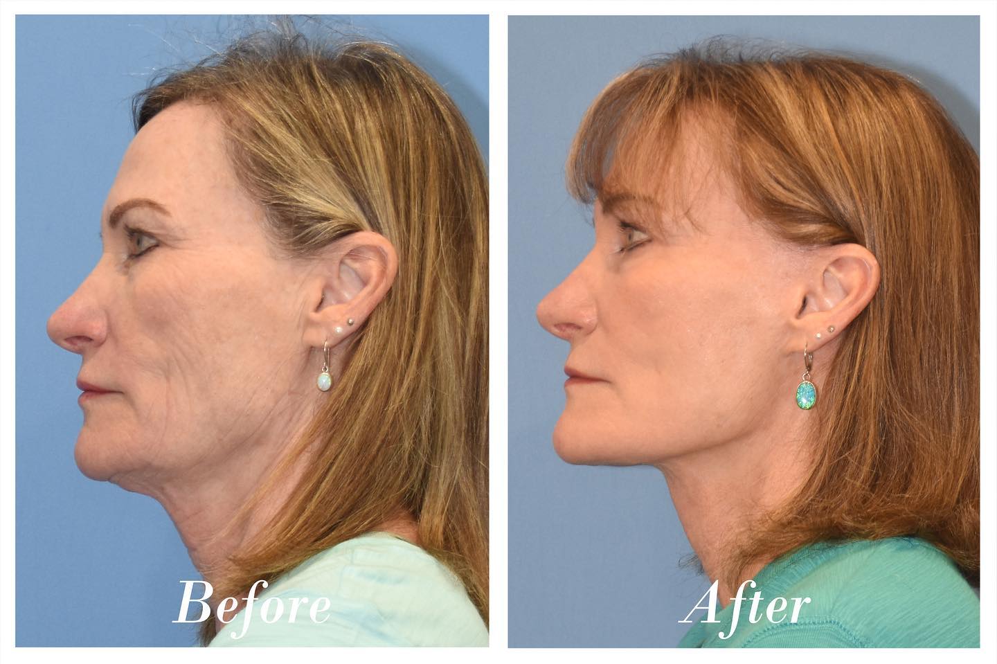 Facelift Before & After Image