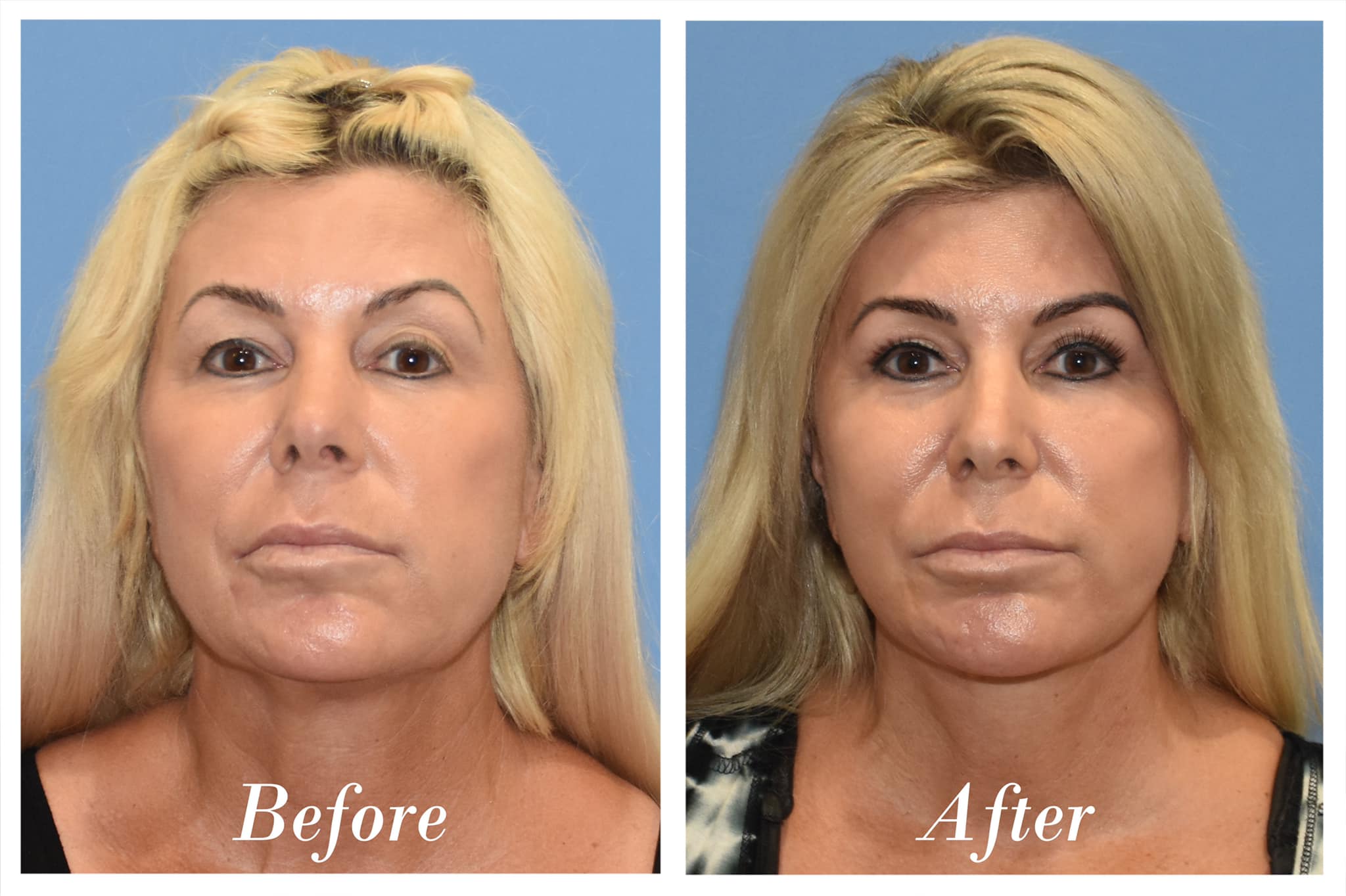 Facelift Before & After Image