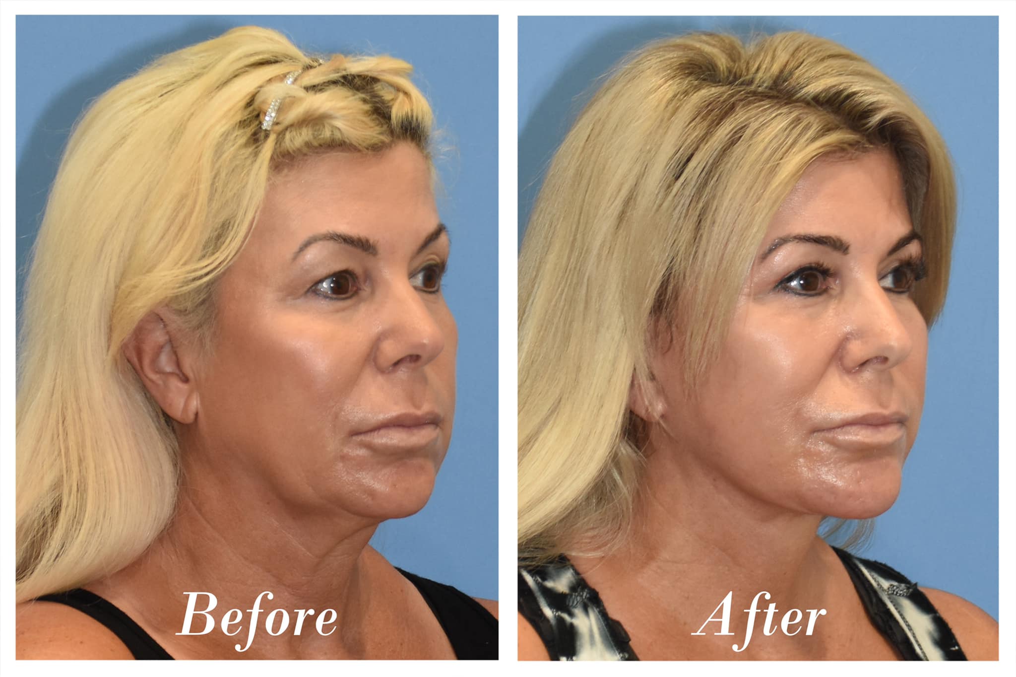 Facelift Before & After Image