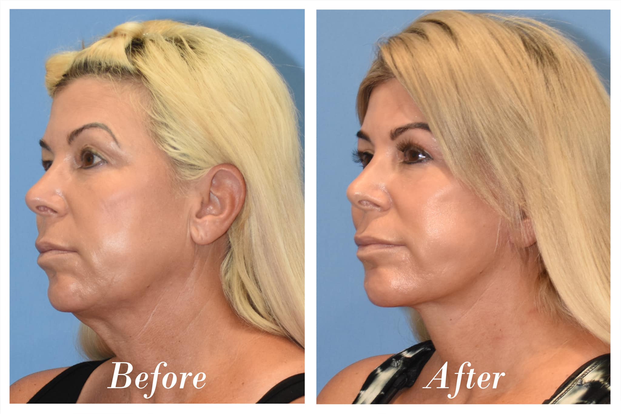 Facelift Before & After Image