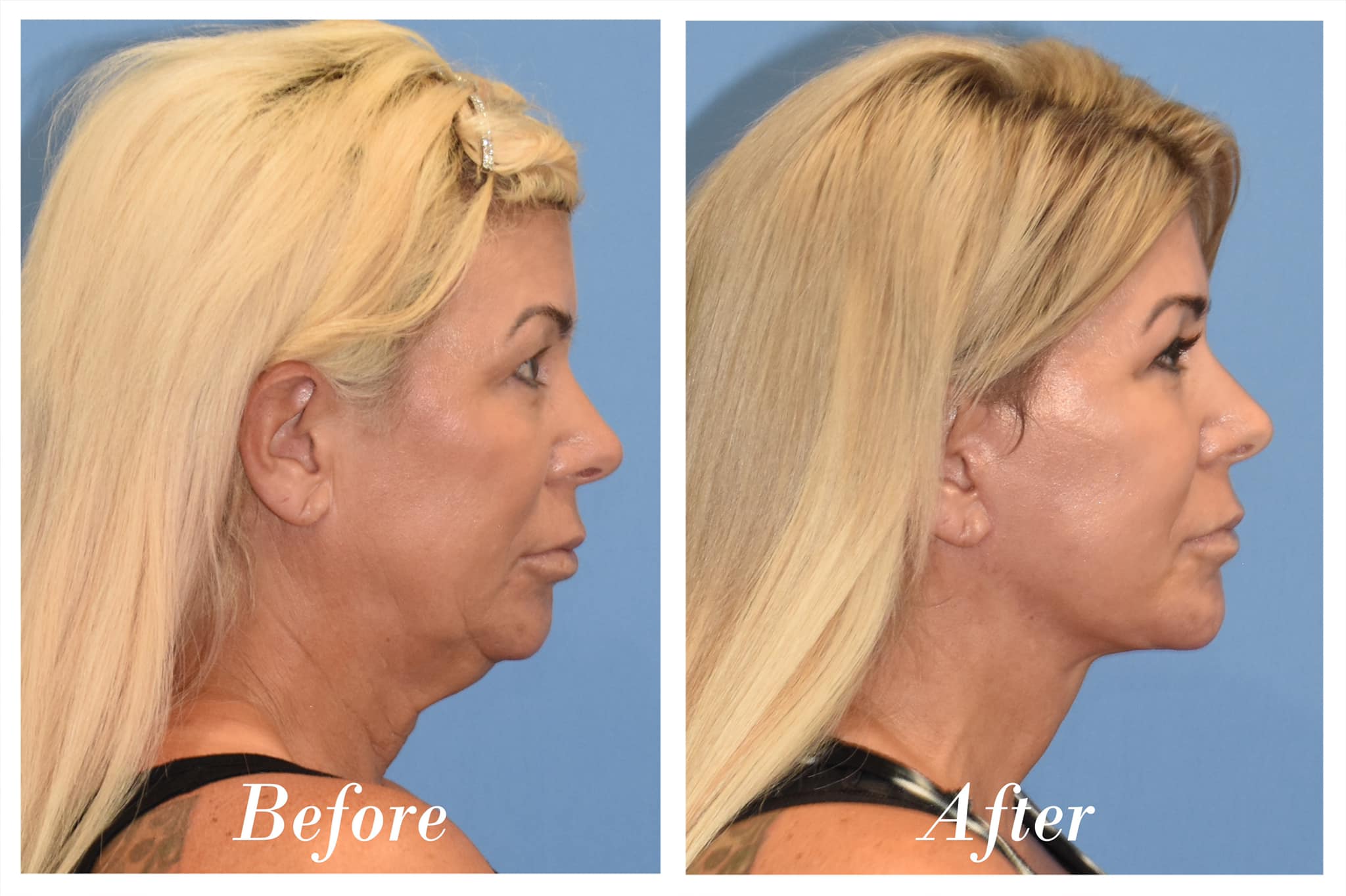 Facelift Before & After Image