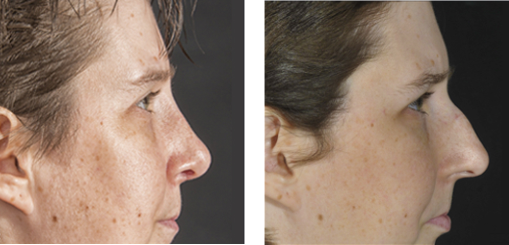 Rhinoplasty Before & After Image