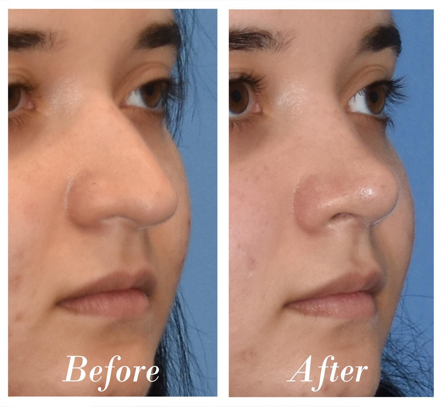 Rhinoplasty Before & After Image