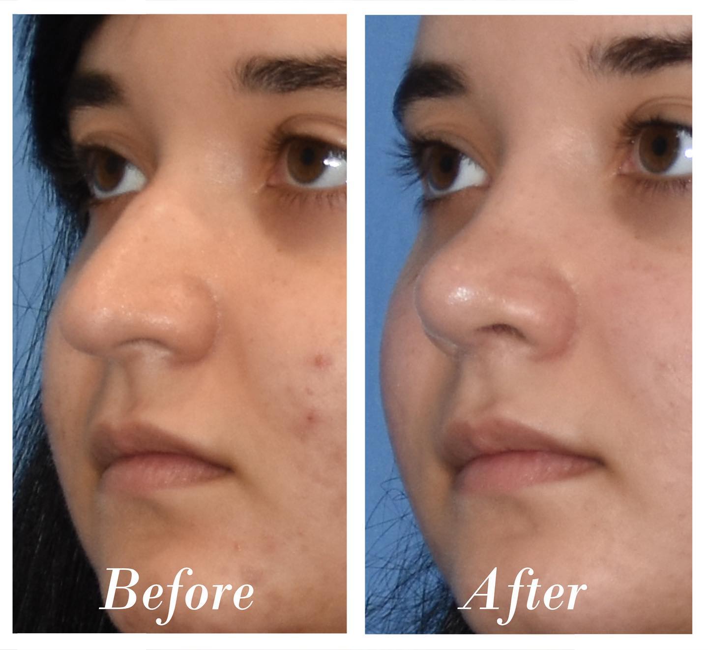 Rhinoplasty Before & After Image