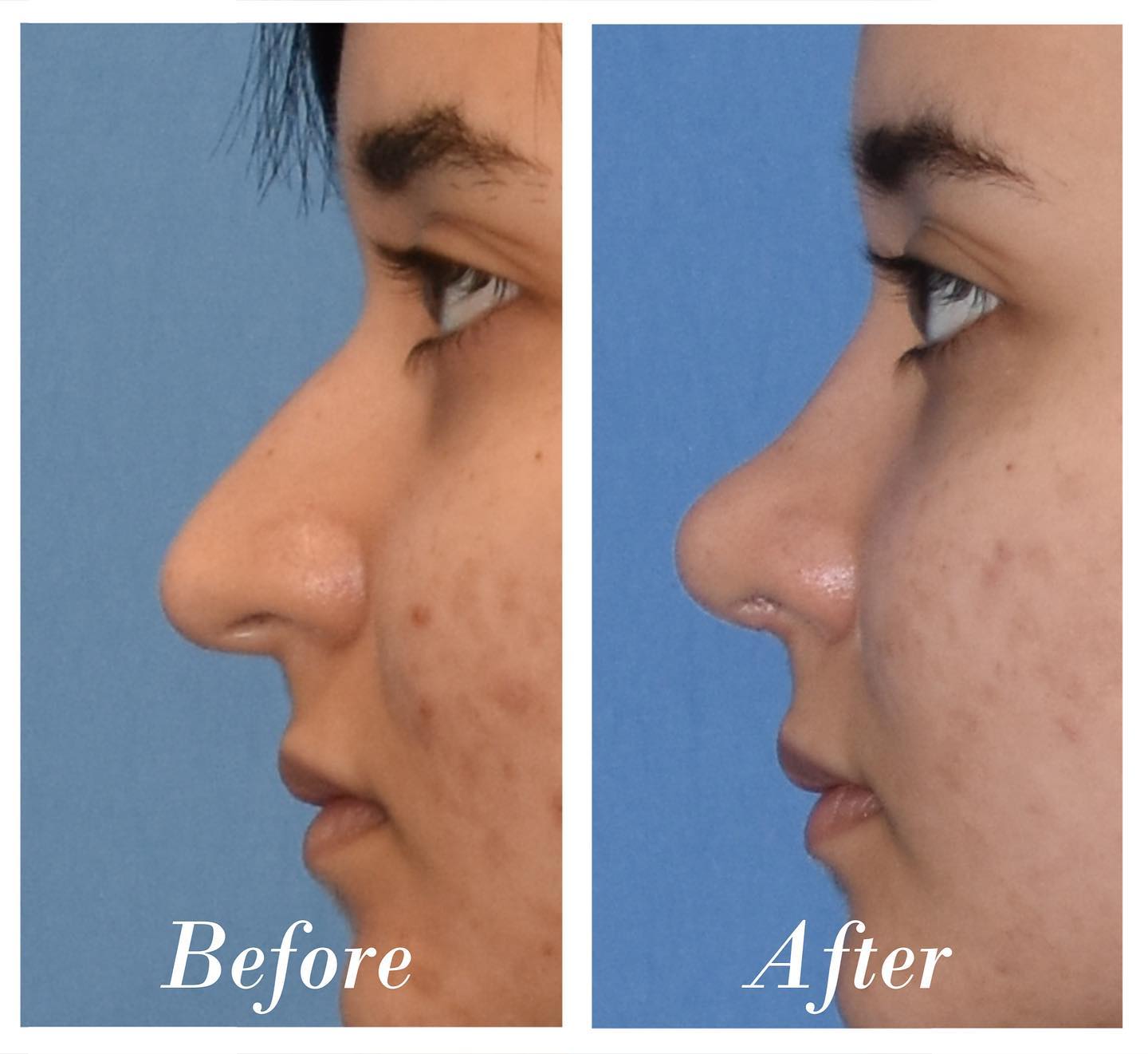 Rhinoplasty Before & After Image