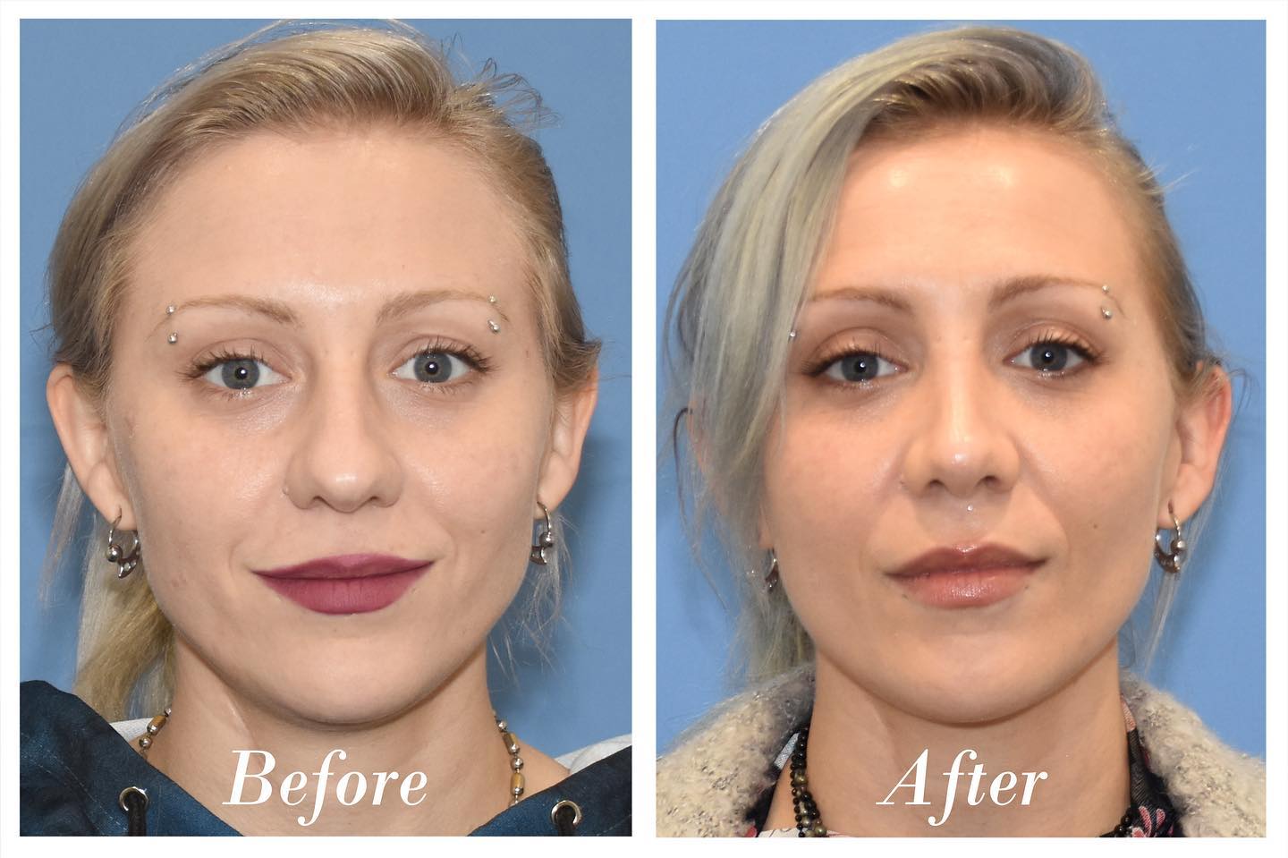 Rhinoplasty Before & After Image