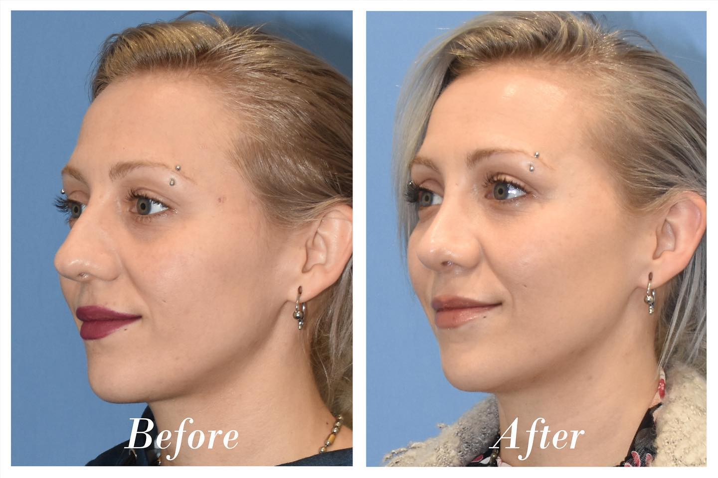 Rhinoplasty Before & After Image