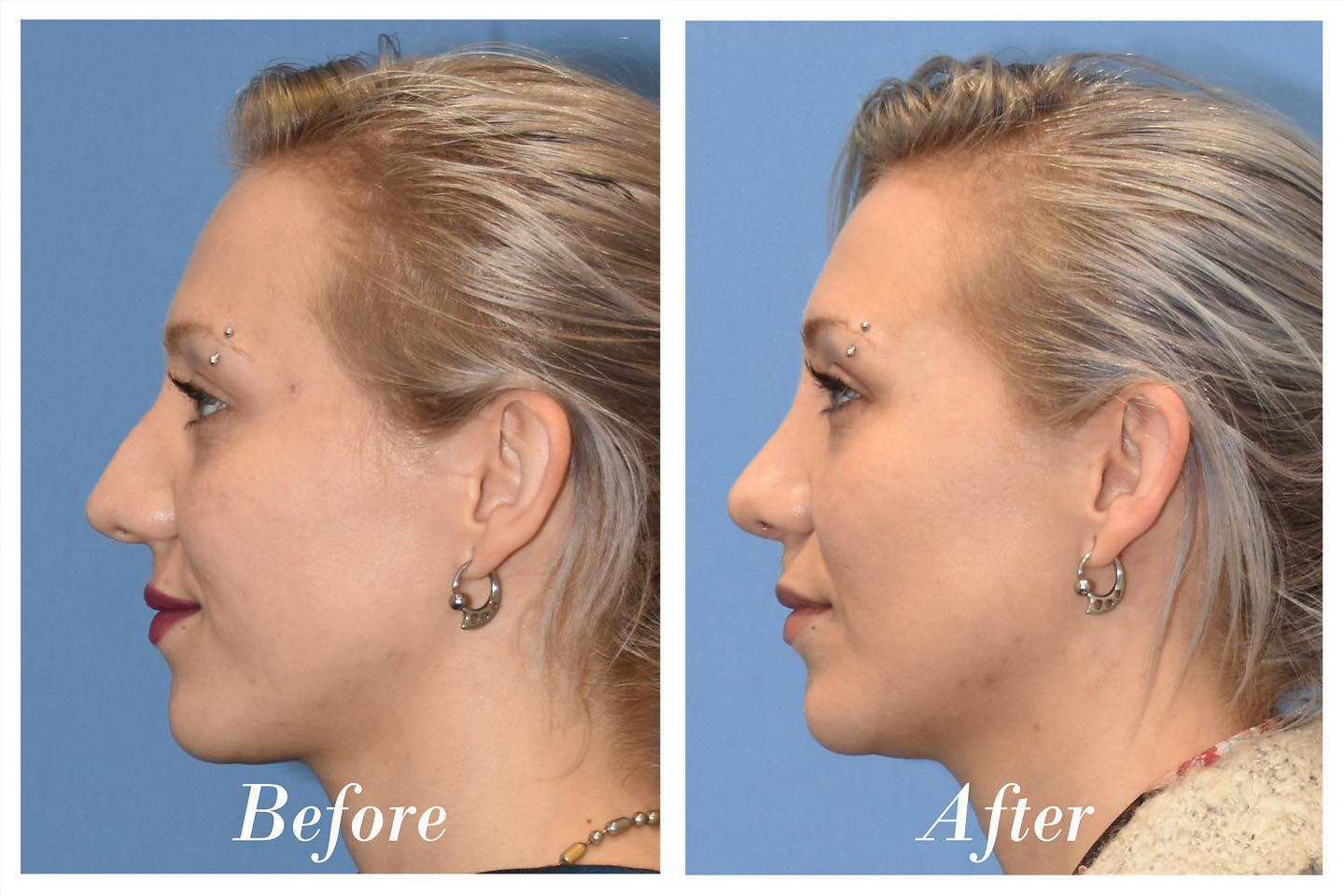 Rhinoplasty Before & After Image