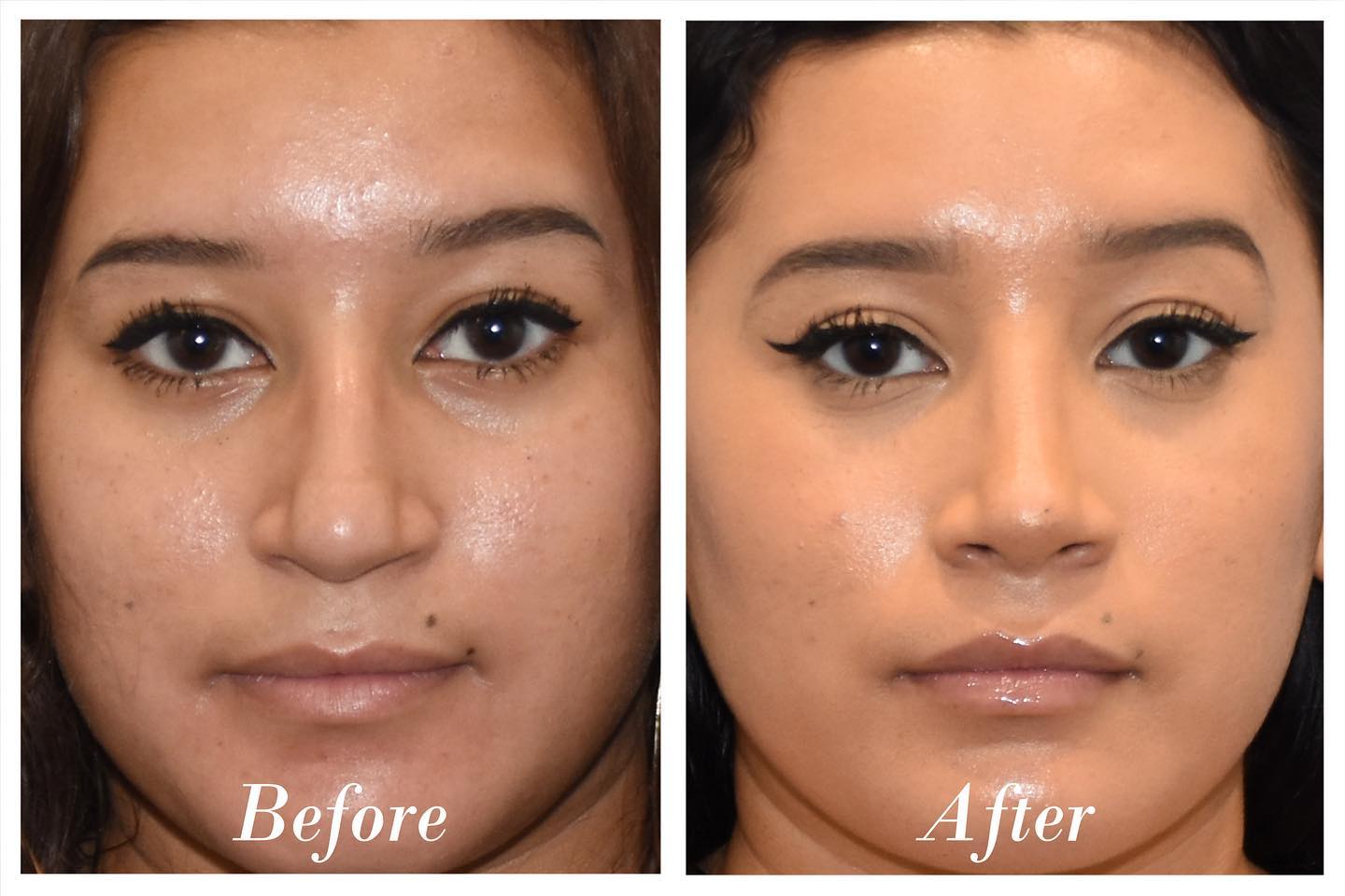 Rhinoplasty Before & After Image