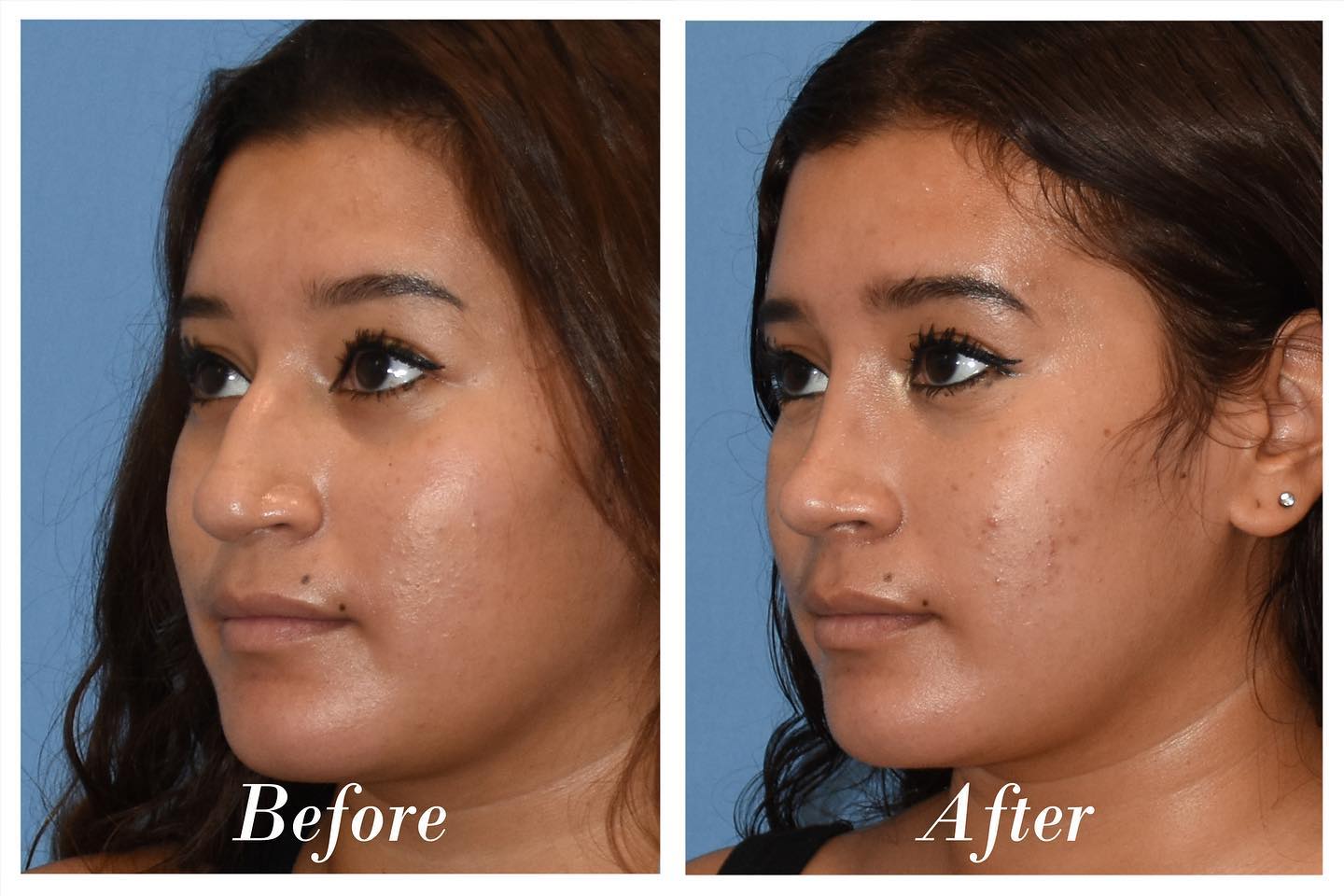 Rhinoplasty Before & After Image